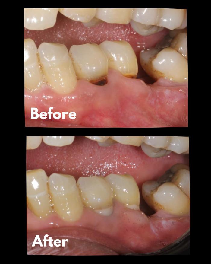 before after
